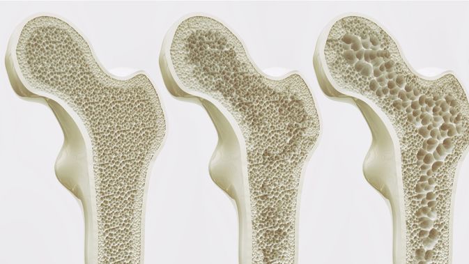 Perkiraan WHO di Tahun 2050 Perihal Patah Tulang atau Osteoporosis